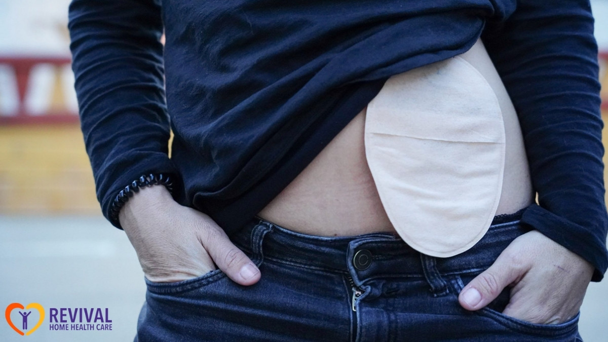 Living Comfortably With an Ostomy: Tips From Home Health Nurses